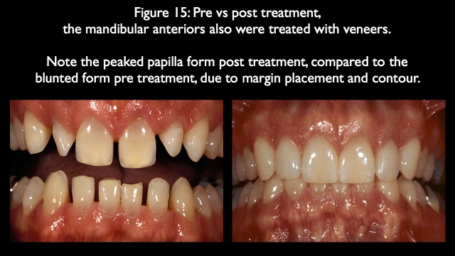 Orthodontic vs. Restorative: Correction of Mal-Aligned Anterior Teeth Frank Spear Orthodontic vs. Restorative Correction of Mal Aligned Anterior Teeth figure 15