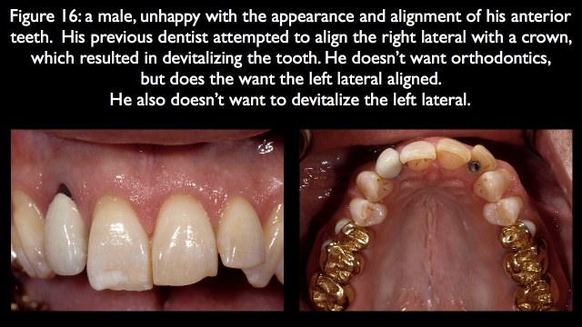 Orthodontic vs. Restorative: Correction of Mal-Aligned Anterior Teeth Frank Spear Orthodontic vs. Restorative Correction of Mal Aligned Anterior Teeth figure 16