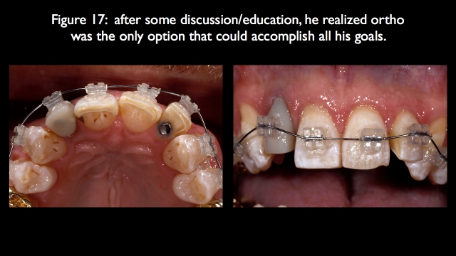 Orthodontic vs. Restorative: Correction of Mal-Aligned Anterior Teeth Frank Spear Orthodontic vs. Restorative Correction of Mal Aligned Anterior Teeth figure 17