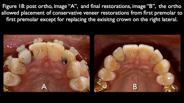 Orthodontic vs. Restorative: Correction of Mal-Aligned Anterior Teeth Frank Spear Orthodontic vs. Restorative Correction of Mal Aligned Anterior Teeth figure 18