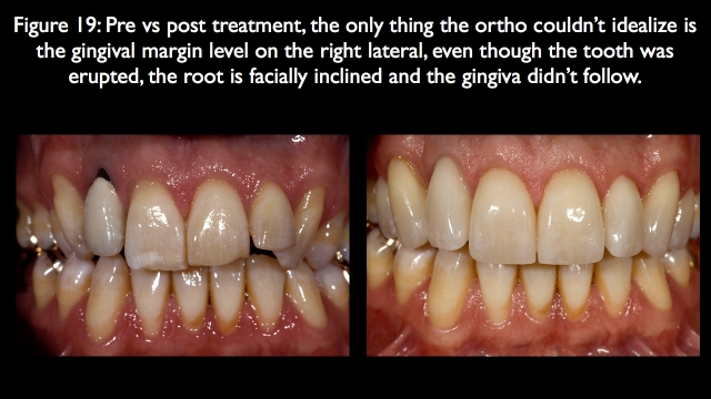 Orthodontic vs. Restorative: Correction of Mal-Aligned Anterior Teeth Frank Spear Orthodontic vs. Restorative Correction of Mal Aligned Anterior Teeth figure 19