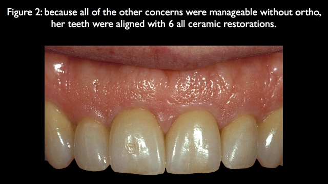 Orthodontic vs. Restorative: Correction of Mal-Aligned Anterior Teeth Frank Spear Orthodontic vs. Restorative Correction of Mal Aligned Anterior Teeth figure 2