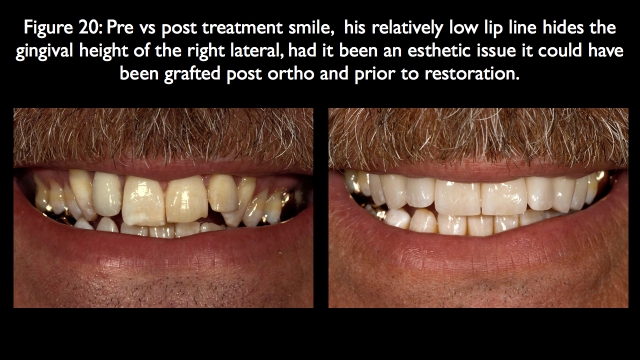 Orthodontic vs. Restorative: Correction of Mal-Aligned Anterior Teeth Frank Spear Orthodontic vs. Restorative Correction of Mal Aligned Anterior Teeth figure 20