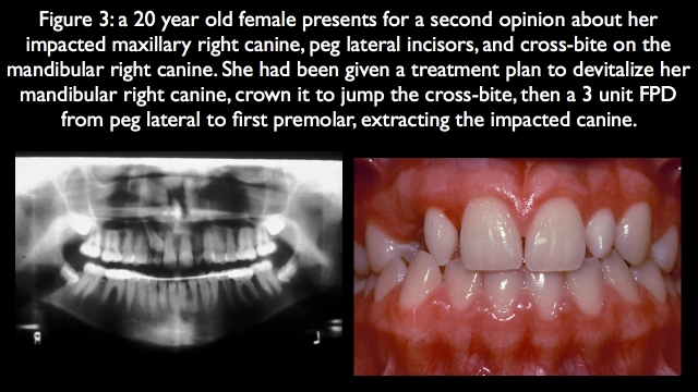 Orthodontic vs. Restorative: Correction of Mal-Aligned Anterior Teeth Frank Spear Orthodontic vs. Restorative Correction of Mal Aligned Anterior Teeth figure 3