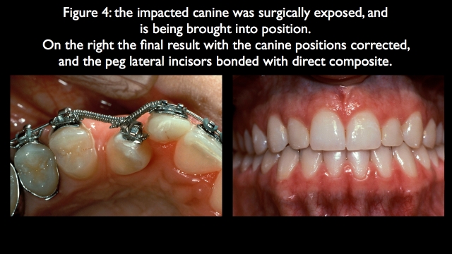 Orthodontic vs. Restorative: Correction of Mal-Aligned Anterior Teeth Frank Spear Orthodontic vs. Restorative Correction of Mal Aligned Anterior Teeth figure 4