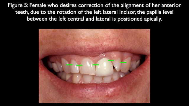 Orthodontic vs. Restorative: Correction of Mal-Aligned Anterior Teeth Frank Spear Orthodontic vs. Restorative Correction of Mal Aligned Anterior Teeth figure 5