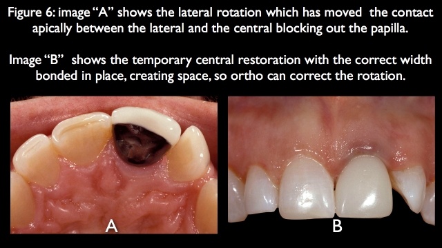 Orthodontic vs. Restorative: Correction of Mal-Aligned Anterior Teeth Frank Spear Orthodontic vs. Restorative Correction of Mal Aligned Anterior Teeth figure 6