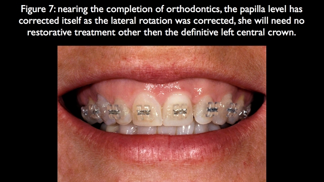 Orthodontic vs. Restorative: Correction of Mal-Aligned Anterior Teeth Frank Spear Orthodontic vs. Restorative Correction of Mal Aligned Anterior Teeth figure 7