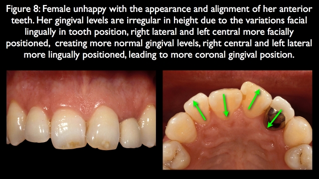 Orthodontic vs. Restorative: Correction of Mal-Aligned Anterior Teeth Frank Spear Orthodontic vs. Restorative Correction of Mal Aligned Anterior Teeth figure 8