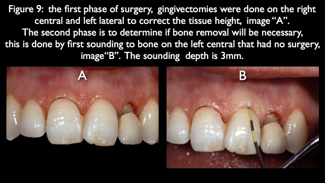 Orthodontic vs. Restorative: Correction of Mal-Aligned Anterior Teeth Frank Spear Orthodontic vs. Restorative Correction of Mal Aligned Anterior Teeth figure 9