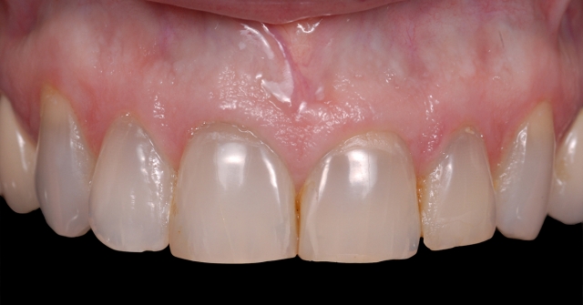 Greggory Kinzer veneer preparations when to break interproximal contact Fig 3a