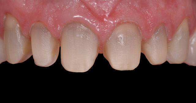 Greggory Kinzer veneer preparations when to break interproximal contact Fig 3b