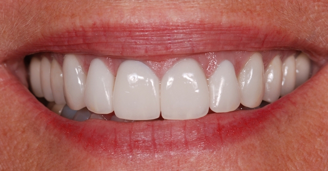 Greggory Kinzer veneer preparations when to break interproximal contact Fig 3c