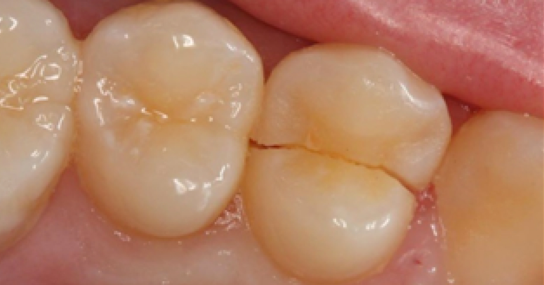 Cracked Cusp Treatment: Essential Guide to 5 Tooth Cracks Close-up of a posterior tooth crack illustrating when cracked cusp treatment is needed
