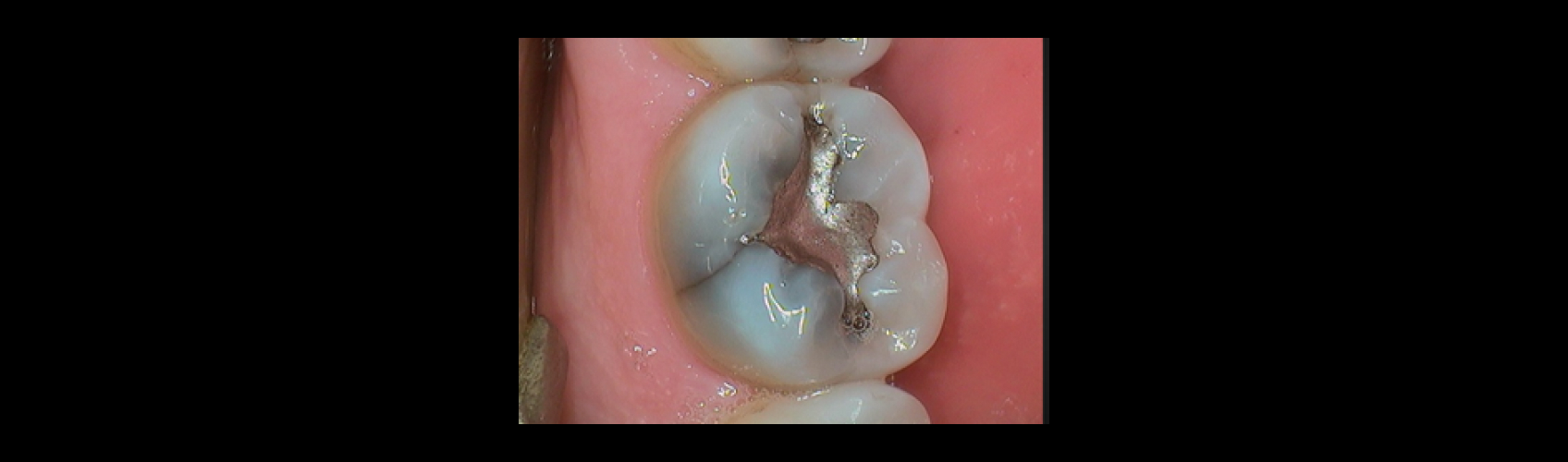 efrver Molar with an aging amalgam restoration and a visible crack extending across the occlusal surface, a case requiring cracked cusp treatment evaluation