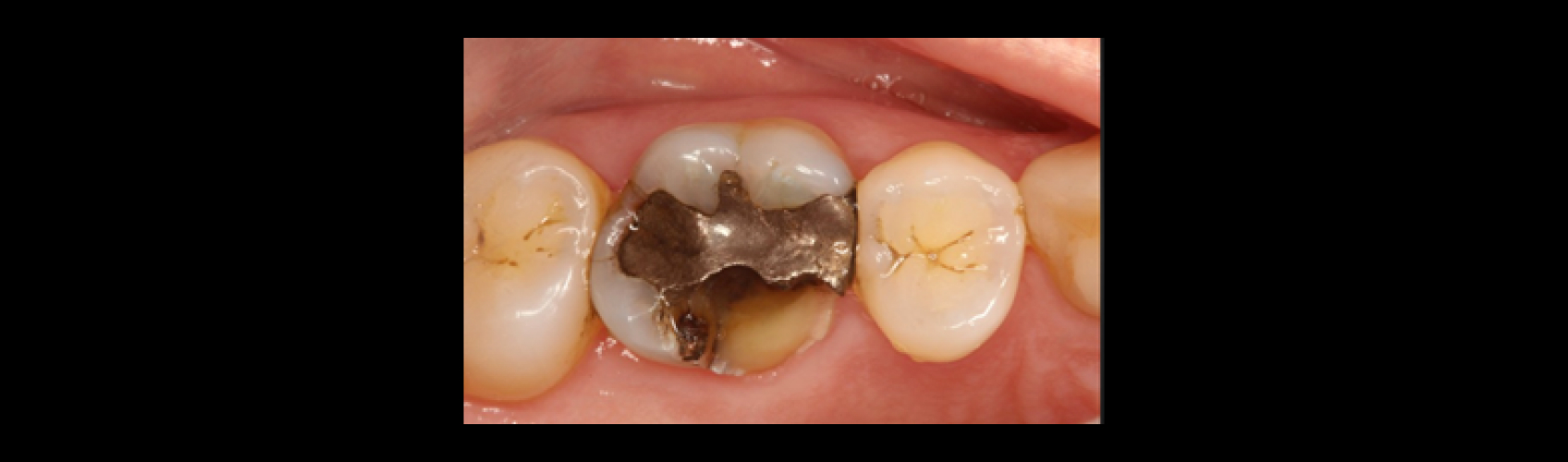 efrver Posterior tooth with a large amalgam restoration and visible crack lines illustrating when cracked cusp treatment becomes necessary