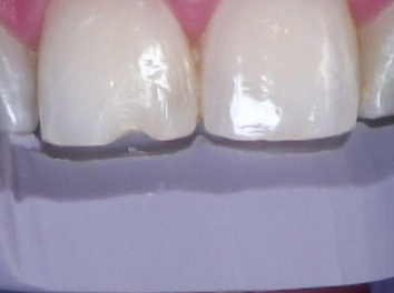 8 Steps for the Esthetic 'Emergency' Anterior Composite image 1