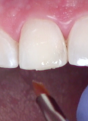 8 Steps for the Esthetic 'Emergency' Anterior Composite image 10