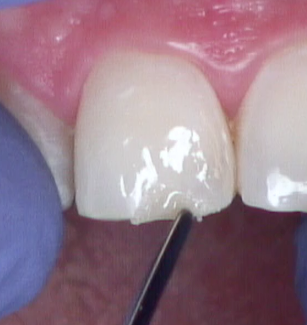 8 Steps for the Esthetic 'Emergency' Anterior Composite image 11