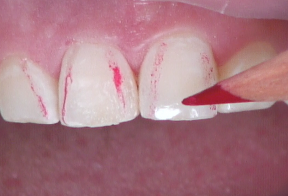 8 Steps for the Esthetic 'Emergency' Anterior Composite image 12