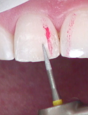 8 Steps for the Esthetic 'Emergency' Anterior Composite image 13