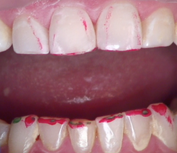 8 Steps for the Esthetic 'Emergency' Anterior Composite image 14