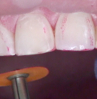 8 Steps for the Esthetic 'Emergency' Anterior Composite image 15