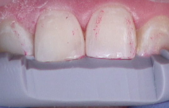 8 Steps for the Esthetic 'Emergency' Anterior Composite image 16