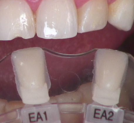 8 Steps for the Esthetic 'Emergency' Anterior Composite image 2