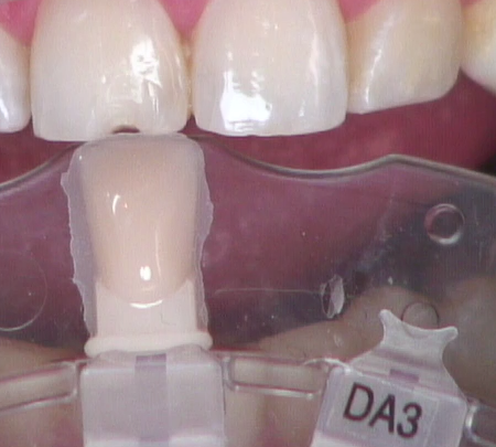 8 Steps for the Esthetic 'Emergency' Anterior Composite image 3