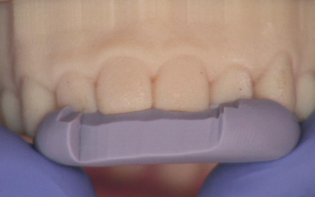 8 Steps for the Esthetic 'Emergency' Anterior Composite image 4