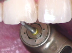 8 Steps for the Esthetic 'Emergency' Anterior Composite image 4