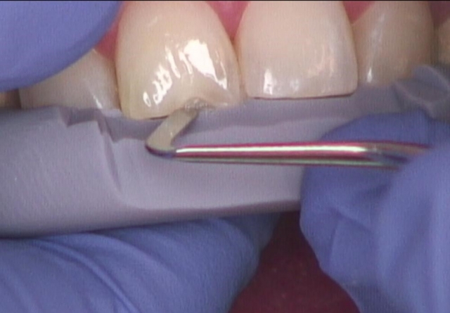 8 Steps for the Esthetic 'Emergency' Anterior Composite image 5