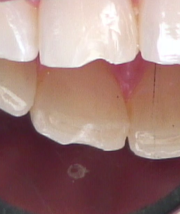 8 Steps for the Esthetic 'Emergency' Anterior Composite image 5