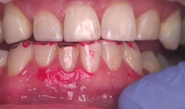 8 Steps for the Esthetic 'Emergency' Anterior Composite image 6