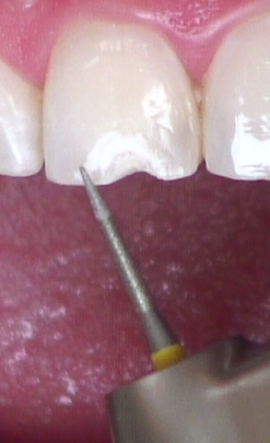 8 Steps for the Esthetic 'Emergency' Anterior Composite image 6