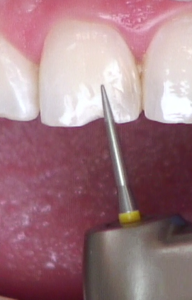 8 Steps for the Esthetic 'Emergency' Anterior Composite image 7