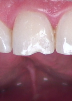 8 Steps for the Esthetic 'Emergency' Anterior Composite image 8