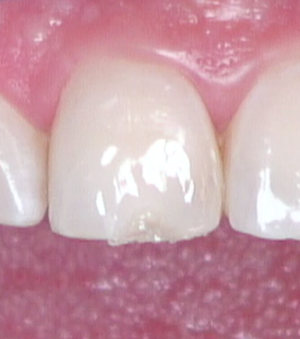 8 Steps for the Esthetic 'Emergency' Anterior Composite image 9