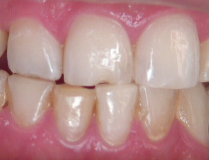 8 Steps for the Esthetic 'Emergency' Anterior Composite image