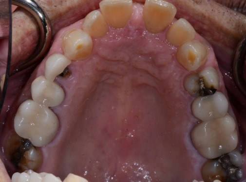 Five Functional Tips for Any Restorative Dentist Bush five functional tips restorative 002