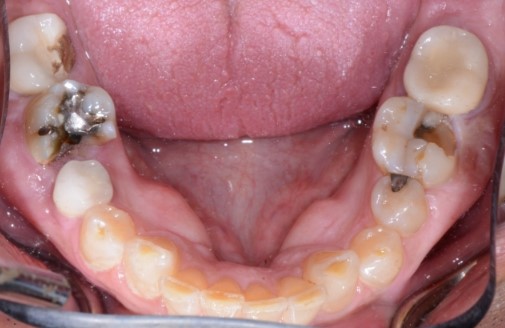 Five Functional Tips for Any Restorative Dentist Bush five functional tips restorative 003