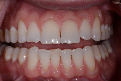 Five Functional Tips for Any Restorative Dentist Bush five functional tips restorative 004