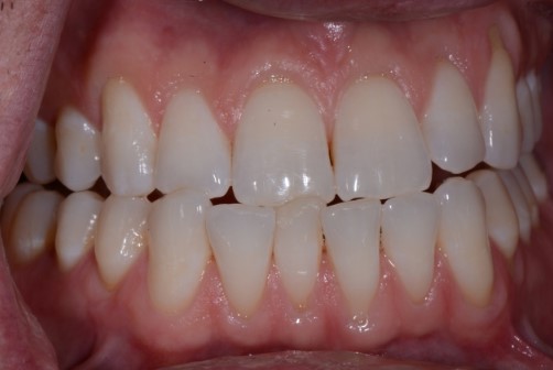 Five Functional Tips for Any Restorative Dentist Bush five functional tips restorative 005