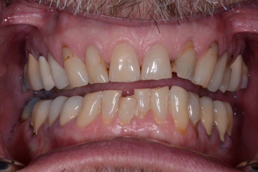 Five Functional Tips for Any Restorative Dentist Bush five functional tips restorative 006