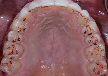 Punishment for ‘Needing’ a MAD: Condemned to Suboptimal Treatment? Fig 10