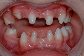 JeffreyBonk managing oligodontia a case report Fig.1