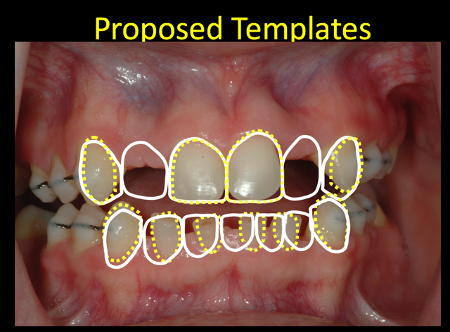 JeffreyBonk managing oligodontia a case report Fig.3