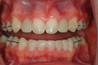 JeffreyBonk managing oligodontia a case report Fig.4