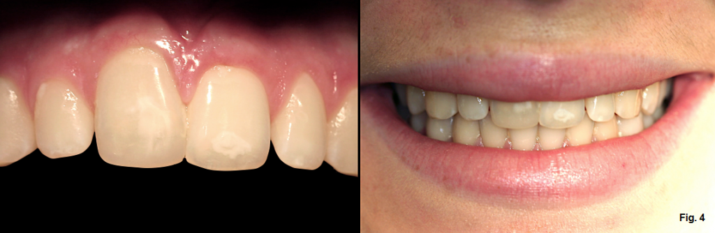 Greggory Kinzer Ankylosis Part III fig4